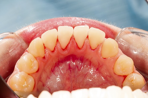 Teeth and irritated gums close up gum disease